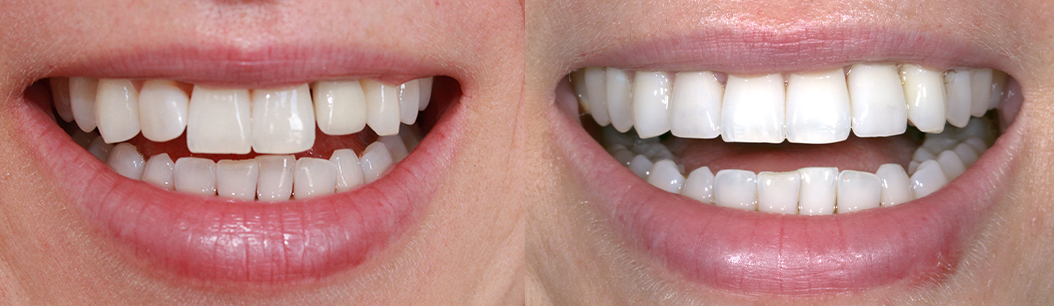 Jonathan Ochi DDS | Inlays  amp  Onlays, Full Mouth Rejuvenation and Sports Mouthguards