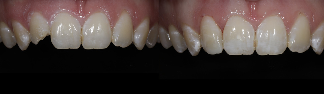 Jonathan Ochi DDS | Dentures, Inlays  amp  Onlays and ClearCorrect reg 